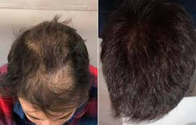 It has been suggested that there is a connection between marijuana smoking and hair loss. Folital Reviews Risky Scam Concerns Or Safe Supplement Homer News