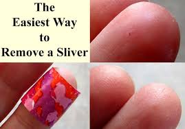Maybe you would like to learn more about one of these? The Easiest Way To Remove A Sliver The Homesteading Hippy