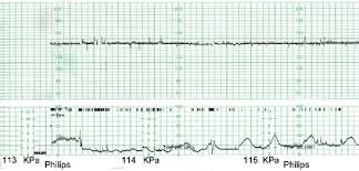 note fixed fetal heart rate pattern with loss of variability