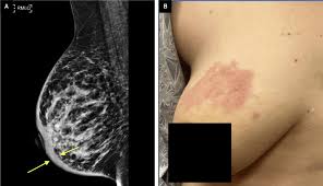 Image result for Inflammatory breast cancer