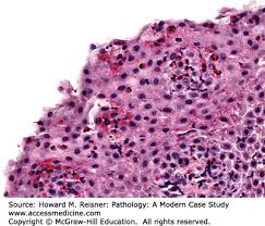 Diagnostics and treatment of infectious esophagitis: Pathology Of The Gastrointestinal Tract Basicmedical Key