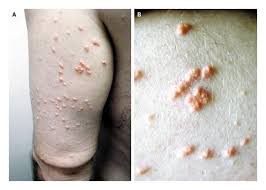 Image result for Hypertriglyceridemia