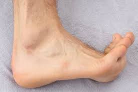 Fersensporn Plantarfasziits Gelenk Klinik De