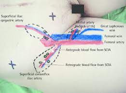 Imagine having hot knives stabbing directly into your have you tried covering the sore area with gauze or something to prevent chaffing? The Anatomical Landmark Shows Options In The Groin Area For The Download Scientific Diagram