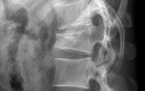 Osteoporose Wirbeleinbruch
