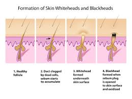 Deep blackheads can be difficult, but not impossible, to get rid of. Nose Blackheads Home Remedies To Remove Black Pores On Nose