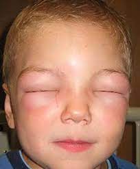 How To Prepare For Allergic Reactions When The Grid Goes Down Allergy Symptoms Allergic Reaction Remedies Allergies