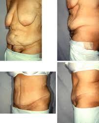 This means if you're getting health coverage for someone 18 or younger, dental coverage must be available for your child either as part of a health. Panniculectomy Non Cosmetic Tummy Tuck Salt Lake City Fairbanks Plastic Surgery Center