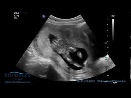 Scan Of The Week 15 Weeks Pregnant The Advanced Early Ultrasound Youtube