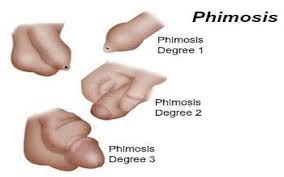 Image result for Phimosis