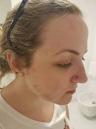 Couple's romantic getaway left in tatters as bloody sheets and bed bug  infestation leaves woman covered in bites