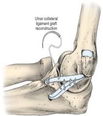 Sang ho baek suffered injuries throughout the season and required tommy john surgery, according to a gofundme. Why Tommy John Doesn T Like The Surgery That Bears His Name Regenexx