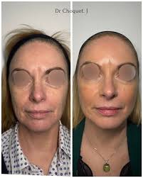 Avant ➝ Après ✨(agent de comblement) Un lifting subtil, sans excès. Chez  Clinique D, nous privilégions des résultats naturels, équilibrés et  élégants. Injection par Dre Danielle Brassard, dermatologue. 📍 Clinique D  📞