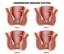 Image result for hemorrhoids