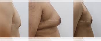 Here you may to know how to tell if you have gynecomastia. How Do I Know If I Have Gynecomastia Or Pseudogynecomastia