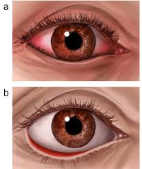 A bandage lens is a great way to manage the abrasion in the short term until you can see your surgeon to flip the lid and remove the offending suture. Entropion And Ectropion Repair Healthdirect