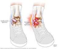Image result for how to treat treatment for sprain