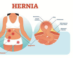 Epigastric hernia in the body