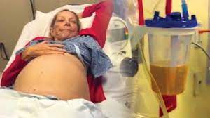 Ennis is pleased to offer drainless tummy tuck, an innovative surgical technique that can eliminate the need for surgical drains in abdominoplasty. How To Perform An Abdominal Fluid Drainage Procedure Nurse Practitioner Student Mrs Starr Youtube