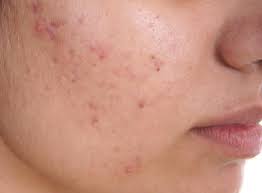 Image result for acne face