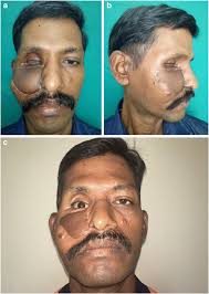 Mucormycosis of the nose and paranasal sinuses. Cranio Facial Mucormycosis The Plastic Surgeon S Perspective Springerlink