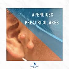Apéndice Preauricular