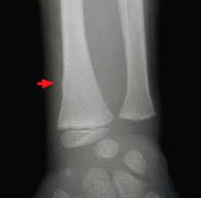 Fracture De La Metaphyse Radiale Chez Un Enfant