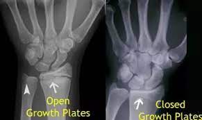 Does A Person Grow When Growth Plates Are Open Or Starting To Fuse/Close? -  Quora