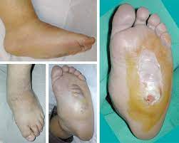 Charcot arthropathy, also called charcot joint or neuropathic joint, is a progressive musculoskeletal disorder characterized by joint subluxation, pathologic fractures, and debilitating deformities. A Case Of Diabetic Charcot Arthropathy Of The Foot And Ankle Nature Reviews Endocrinology
