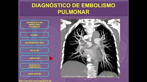 Toda solfa syllable clave sobre síntomas, causas, tratamientos. Tromboembolismo Pulmonar Youtube