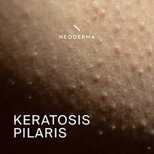 Image result for Keratosis pilaris