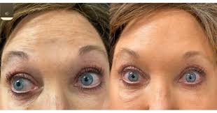 Lines between the eyebrows are caused by a number of factors, including repetitive facial. Botox And Dysport K2 Restorative Medicine Med Spa Dr Pamela Kulback