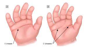Check spelling or type a new query. Palm Creases Pi Uptodate
