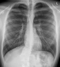 Chest tube insertion is a common procedure usually done for the purpose of draining accumulated air or fluid in the pleural cavity. Pneumothorax Sicher Diagnostizieren Und Therapieren