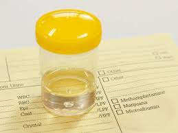 Cul urine culture, urine report source: Clean Catch Urine Sample And Culture