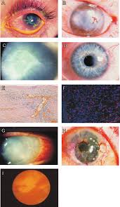 Bacterial infection of the cornea can follow from an injury or from wearing. Macroscopic And Immunohistologic Characteristics Of Herpes Simplex Download Scientific Diagram