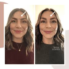 Botox 101: What It Is, How It Works, and What to Expect