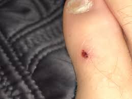 Some cancers occur more frequently in certain age groups. Mark On Little Toe Cancer Forums Patient