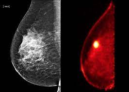 A ct scan may be done to: Breast Pet Scan Breast360 Org The American Society Of Breast Surgeons Foundation
