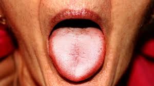 Image result for Puchýře na jazyku