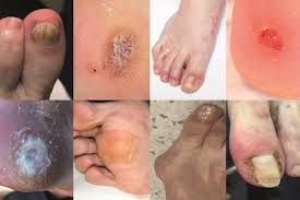 Image result for Onycholysis feet