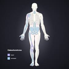 Pin On Osteochondroma Info