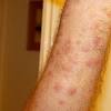 Just an occasional treating of the mites does not result in a cure of the infestation. Https Encrypted Tbn0 Gstatic Com Images Q Tbn And9gctmrtsgol4h Mwraz6xl0i2wuidgbhrq7velduazdrplhzgevma Usqp Cau