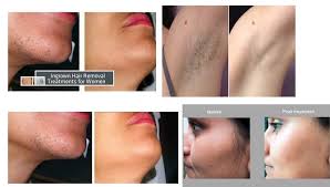 Laser hair removal prices by body part. Permanent Hair Remov On Twitter How Much Does Laser Hair Removal Cost For Face And Full Body Areas Upperliphair Facehair Removeupperliphair Upperliphairremoval Electrolysis Laserhairremoval Laserhairremovalnj Laserhairremoval Aesthetics