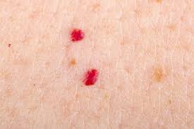 Il se manifeste par une tache. Treatment Of Angiomas With The Lyon Laser Center