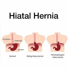 Types Of Hiatal Hernia Hiatus Hernia Hernia Symptoms
