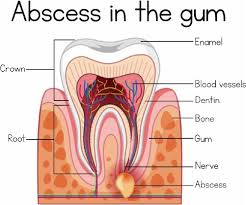 Image result for Periodontal Abscess