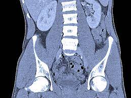 Ucsf colorectal surgeons have decades of experience and expertise in the most challenging and complex cases. Abdominal Ct Scans Definition Uses Picture And More