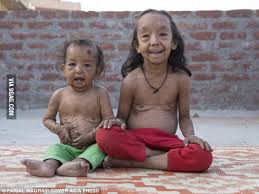 Disease that makes you look old. The Benjamin Button Syndrome Very Rare Skin Disease Makes Kids Look Old 9gag