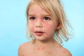 Egg Allergy Belgium Pdf Ppt Case Reports Symptoms Treatment